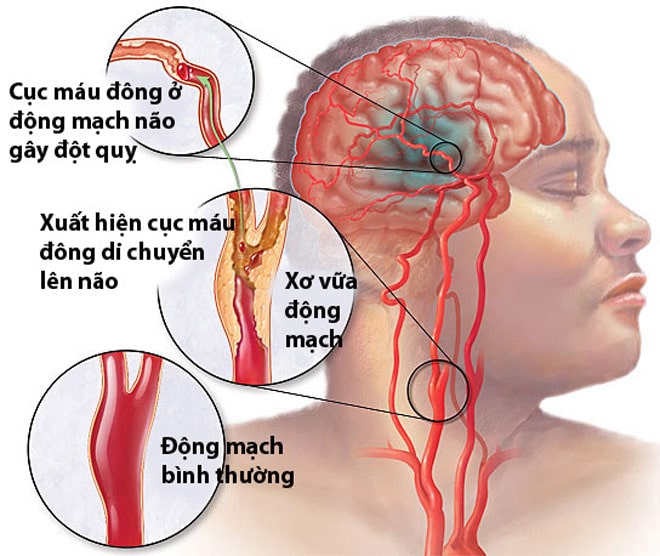 Mỡ máu cao, kẻ giết người thầm lặng