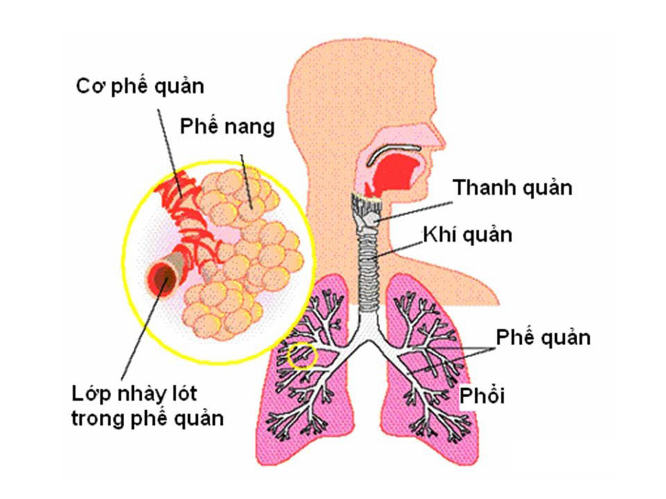 Bệnh Viêm phế quản cấp tính